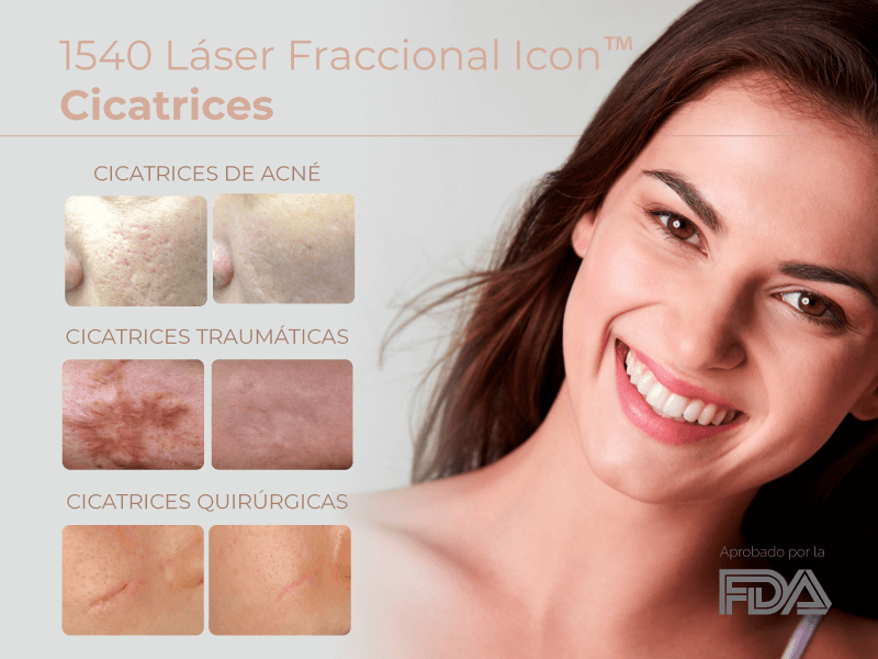 Laser para eliminar cicatrices de acne de cirugia plastica y de accidentes en Medellin