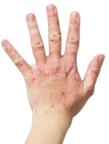 Dermatitis seborreica en Medellin Colombia