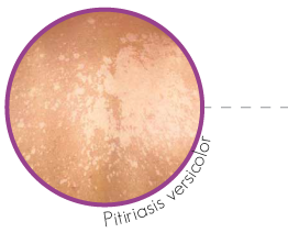 Pitiriasis