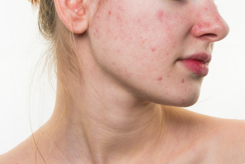 Tratamiento acne en Medellin Colombia