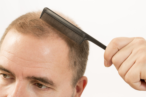 Tratamiento alopecia caida del cabello en Medellin